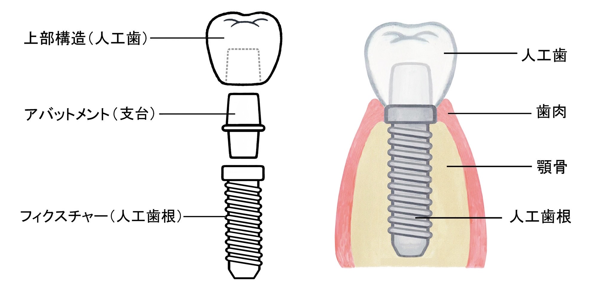 インプラントのイメージ画像