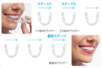 インビザライン矯正治療スタート